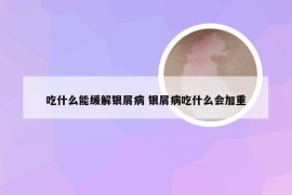 吃什么能缓解银屑病 银屑病吃什么会加重