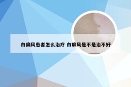 白癞风患者怎么治疗 白癞风是不是治不好