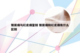 银屑病与红皮病鉴别 银屑病和红皮病有什么区别