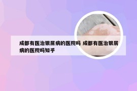 成都有医治银屑病的医院吗 成都有医治银屑病的医院吗知乎