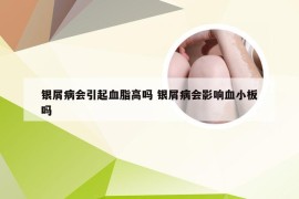 银屑病会引起血脂高吗 银屑病会影响血小板吗