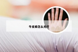 牛皮癣怎么光疗