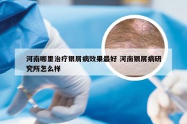 河南哪里治疗银屑病效果最好 河南银屑病研究所怎么样
