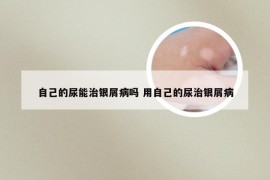 自己的尿能治银屑病吗 用自己的尿治银屑病