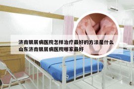 济南银屑病医院怎样治疗最好的方法是什么 山东济南银屑病医院哪家最好