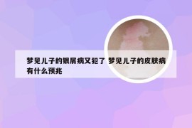 梦见儿子的银屑病又犯了 梦见儿子的皮肤病有什么预兆