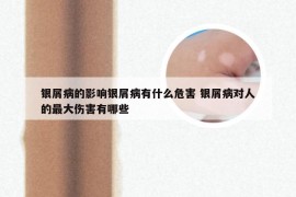 银屑病的影响银屑病有什么危害 银屑病对人的最大伤害有哪些