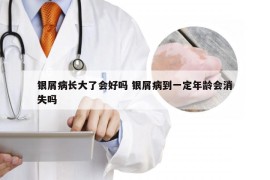 银屑病长大了会好吗 银屑病到一定年龄会消失吗
