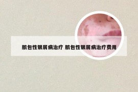 脓包性银屑病治疗 脓包性银屑病治疗费用