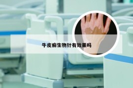 牛皮癣生物针有效果吗