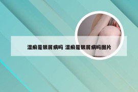 湿癣是银屑病吗 湿癣是银屑病吗图片