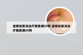 退银祛屑汤治疗银屑病55例 退银祛屑汤治疗银屑病55例