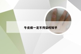 牛皮癣一定不传染吗知乎