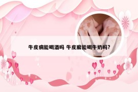 牛皮病能喝酒吗 牛皮廨能喝牛奶吗?