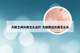 大腿之间长癣怎么治疗 大腿两边长癣怎么办