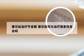 泰尔丝治疗牛皮癣 泰尔丝可以治疗激素性皮炎吗