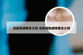 皮肤做病理多少钱 皮肤病做病理要多少钱