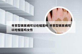寻常型银屑病可以吃榴莲吗 寻常型银屑病可以吃榴莲吗女性