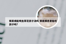 银屑病能喝虫草花鸽子汤吗 银屑病患者能吃鸽子吗?