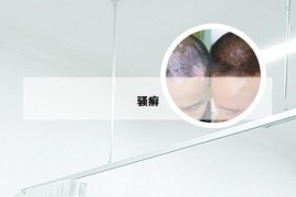 骚癣