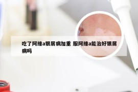 吃了阿维a银屑病加重 服阿维a能治好银屑病吗