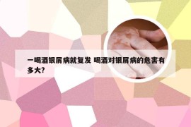 一喝酒银屑病就复发 喝酒对银屑病的危害有多大?