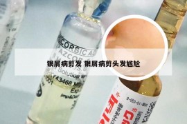 银屑病剪发 银屑病剪头发尴尬