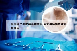 后天得了牛皮癣会遗传吗 后天引起牛皮肤癣的原因