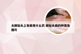 太脚趾头上有癣用什么药 脚趾头癣的种类及图片