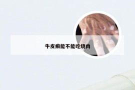 牛皮癣能不能吃烧肉