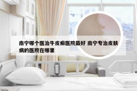 南宁哪个医治牛皮癣医院最好 南宁专治皮肤病的医院在哪里
