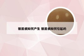 银屑病如何产生 银屑病如何引起的