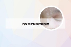 西安牛皮癣皮肤病医院