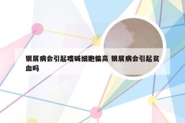银屑病会引起嗜碱细胞偏高 银屑病会引起贫血吗