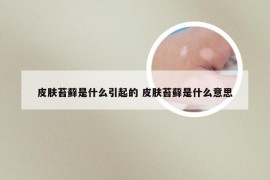 皮肤苔藓是什么引起的 皮肤苔藓是什么意思