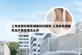 上海皮肤科银屑病最好的医院 上海皮肤病医院治疗银屑病怎么样