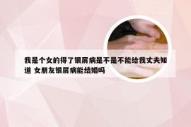 我是个女的得了银屑病是不是不能给我丈夫知道 女朋友银屑病能结婚吗