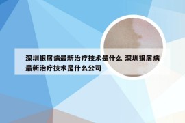 深圳银屑病最新治疗技术是什么 深圳银屑病最新治疗技术是什么公司