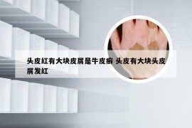 头皮红有大块皮屑是牛皮癣 头皮有大块头皮屑发红