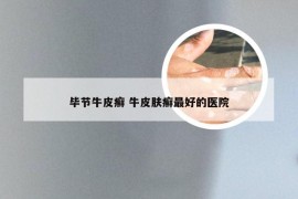 毕节牛皮癣 牛皮肤癣最好的医院