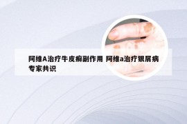 阿维A治疗牛皮癣副作用 阿维a治疗银屑病专家共识