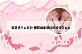 银屑病伤口红肿 银屑病皮损红肿疼痛怎么办