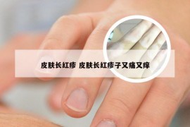 皮肤长红疹 皮肤长红疹子又痛又痒