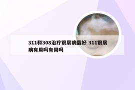 311和308治疗银屑病最好 311银屑病有用吗有用吗