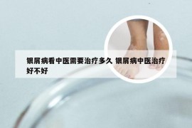 银屑病看中医需要治疗多久 银屑病中医治疗好不好