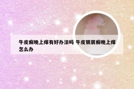 牛皮癣晚上痒有好办法吗 牛皮银屑癣晚上痒怎么办