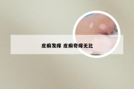 皮癣发痒 皮癣奇痒无比