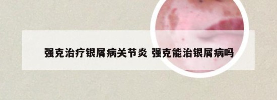 强克治疗银屑病关节炎 强克能治银屑病吗
