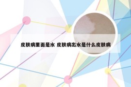 皮肤病里面是水 皮肤病出水是什么皮肤病