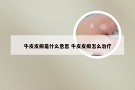 牛皮皮癣是什么意思 牛皮皮癣怎么治疗